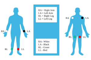 4 lead ecg placement
