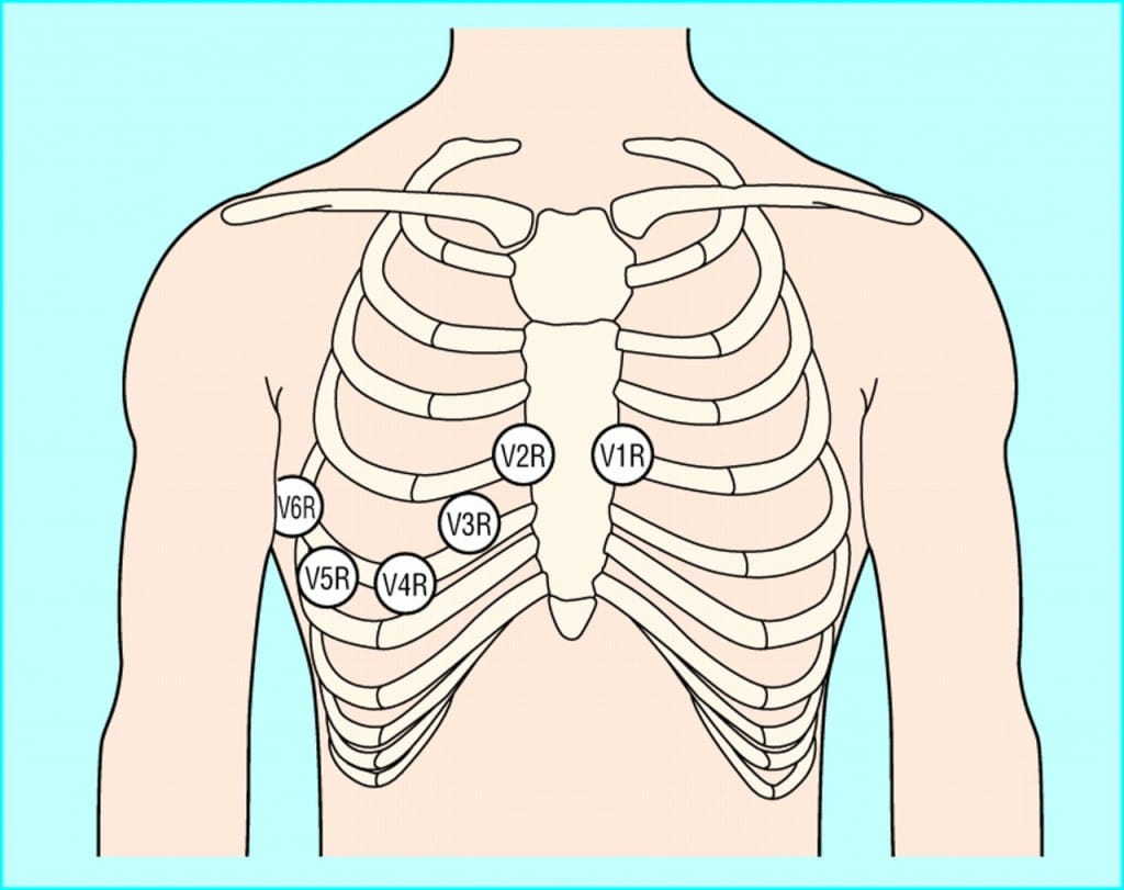 12 lead ecg placement mnemonic