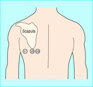 posterior 15-lead placement