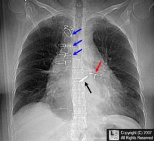 ribs and sternum wire after cpr breaks ribs